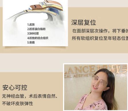 v美减龄是什么手术