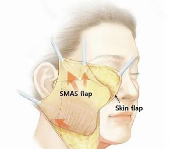 拉皮除皱美容手术可靠性怎么样