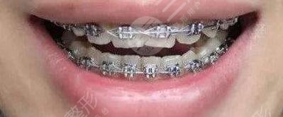 金属矫正牙齿的特点