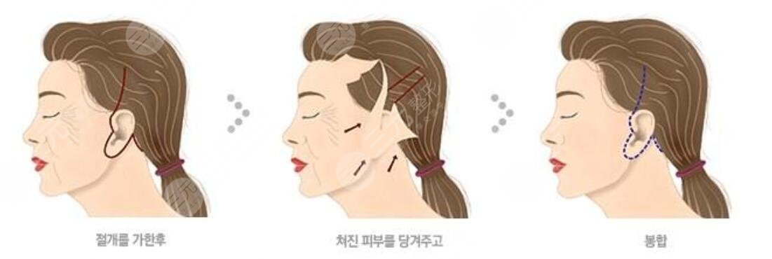 拉皮整形果