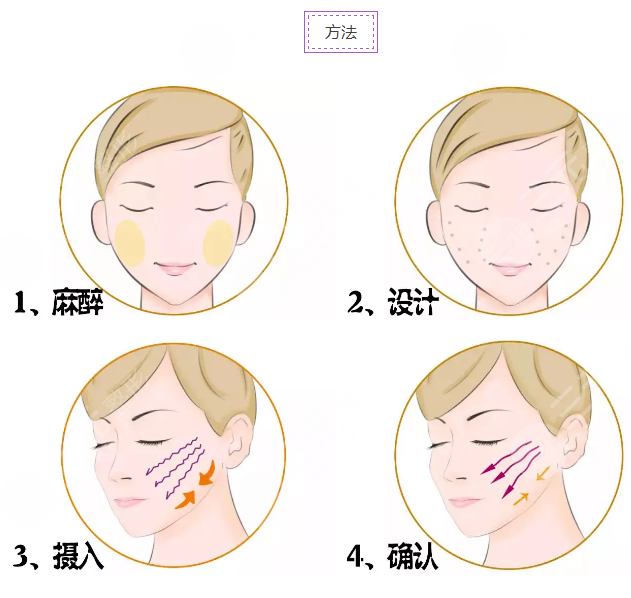 v美骨雕是什么项目