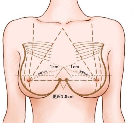 做隆胸手术的注意事项