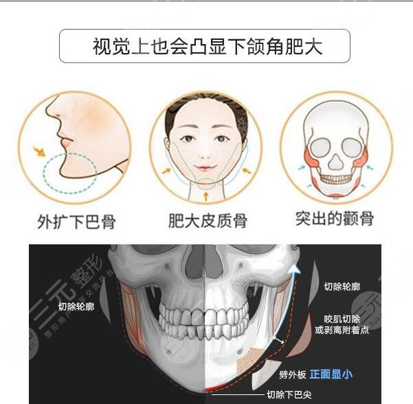 金一秀医生解答磨骨项目科普