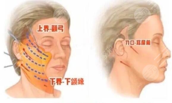 面部除皱术术后该怎么进行护理