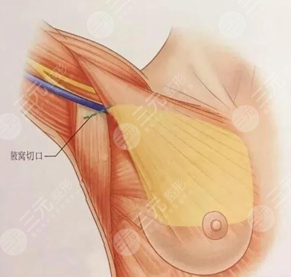 决定找协和医院曾昂丰胸