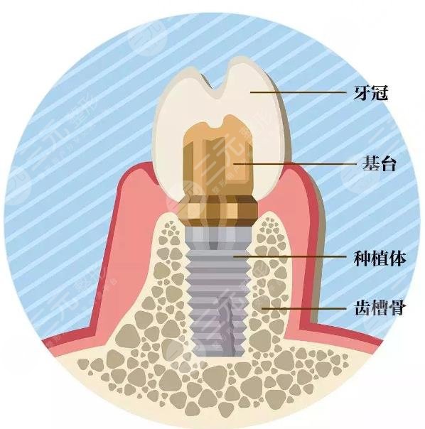 种植牙技术的原理是什么?