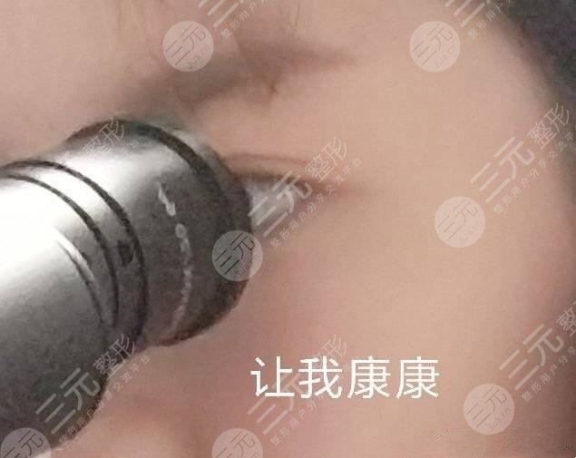 厦门海峡张宏做双眼皮如何？