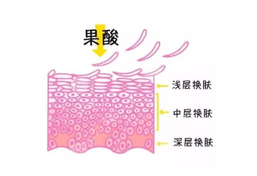 果酸换肤对痘印有吗