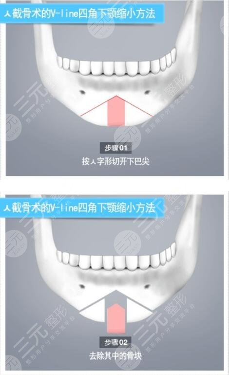 下巴截骨术前注意事项