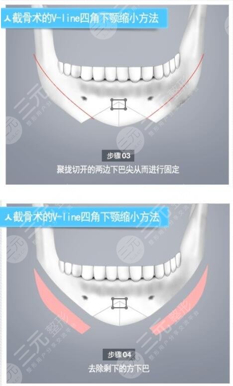 下巴截骨手术过程