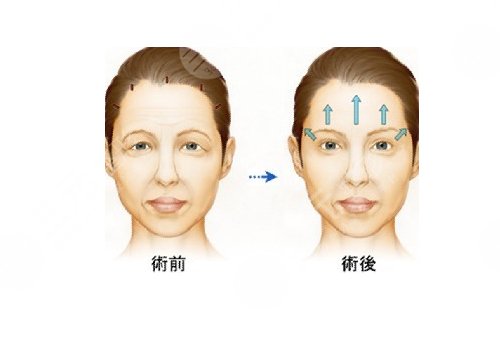 面部拉皮除皱果如何?5种拉皮常见方式科普!小白收藏哦~ 面部拉皮除皱果如何?5种拉皮常见方式科普!小白收藏哦~
