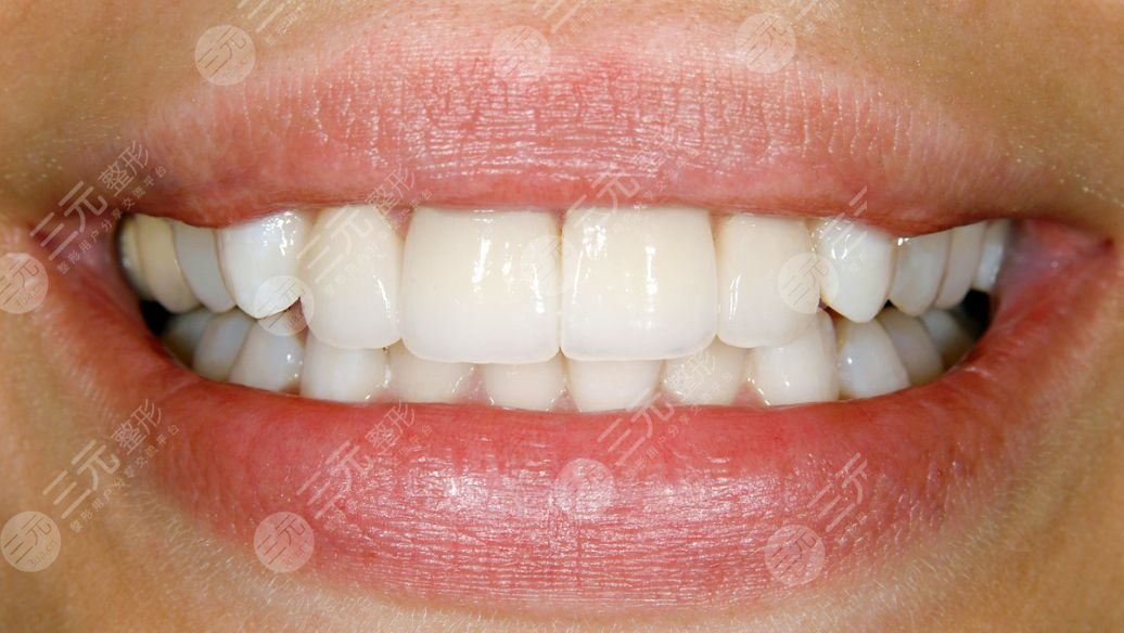 种植牙全口牙需较少种多少颗？有几种方式？科普为你解答4种技术！