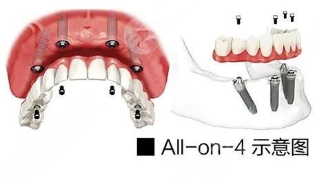 种植牙全口牙需较少种多少颗
