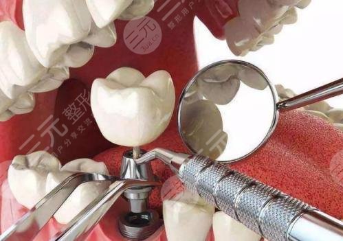 种植牙全口牙需较少种多少颗