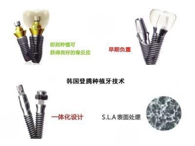 登腾种植牙后期稳定性怎么样