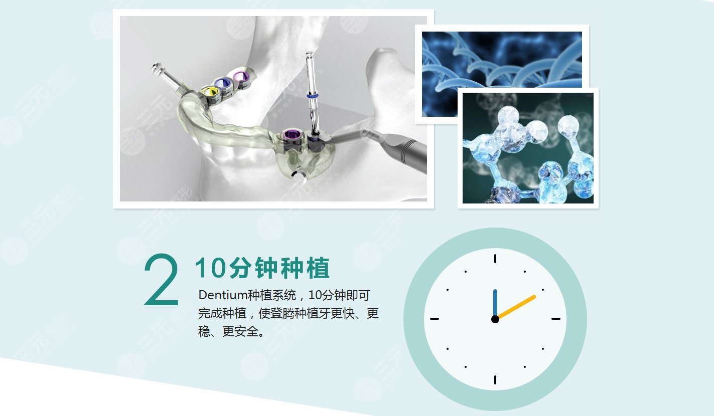 登腾种植牙使用寿命