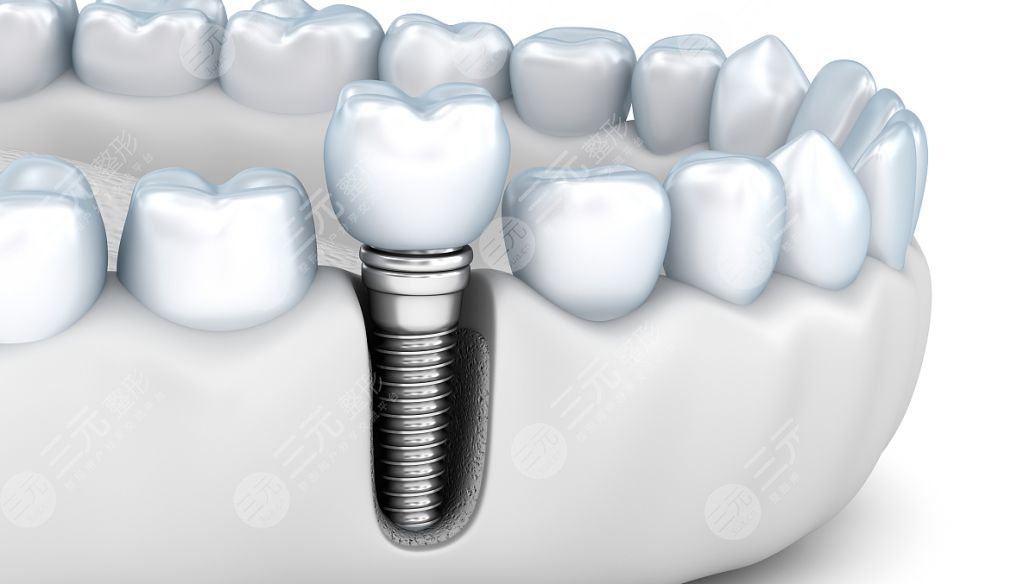 登腾种植牙使用寿命