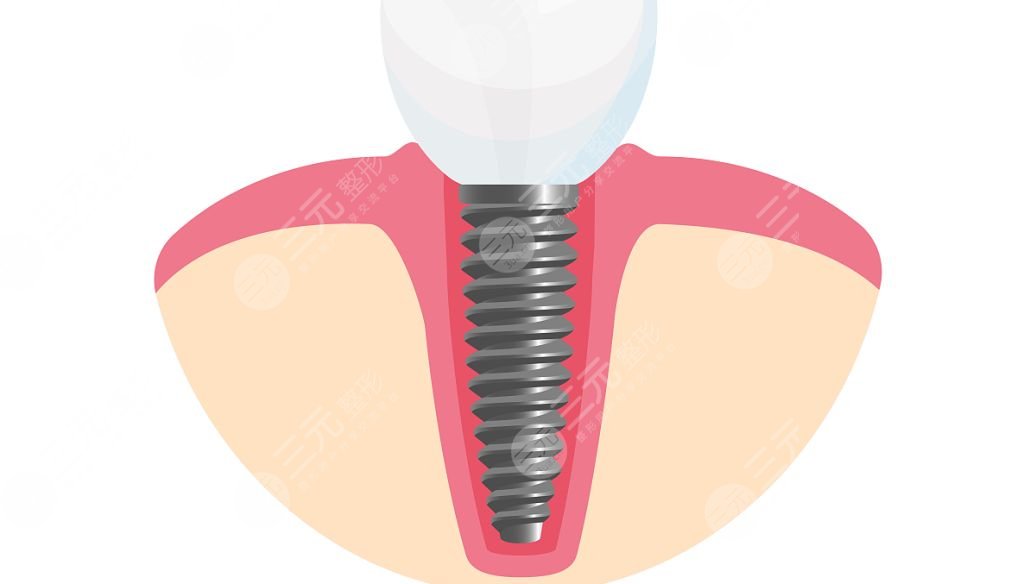 登腾种植牙使用寿命