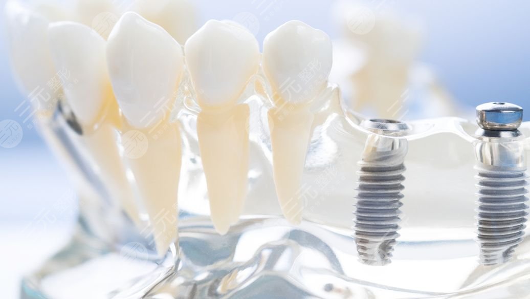 登腾种植牙使用寿命