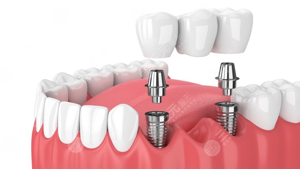 登腾种植牙使用寿命