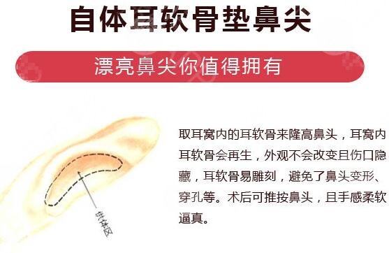 鼻尖缩小手术原理