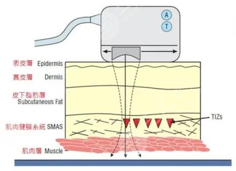 面部除皱术的价格是多少