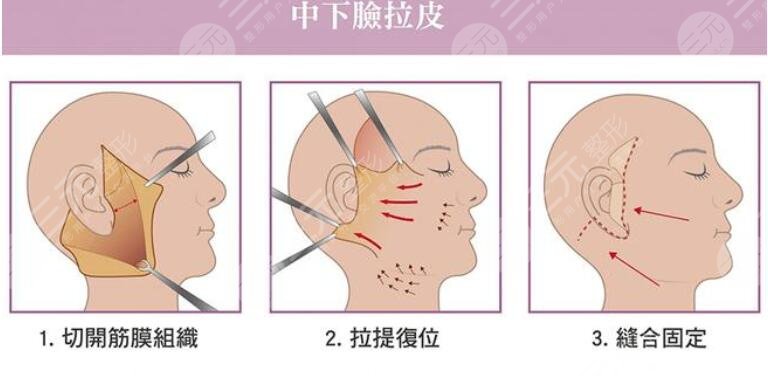 面部拉皮
