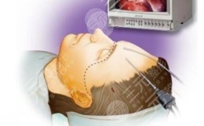 内窥镜拉皮和普通拉皮的区别