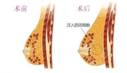 自体脂肪隆胸手术有风险吗