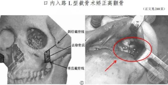 颧骨整形术的疼痛感