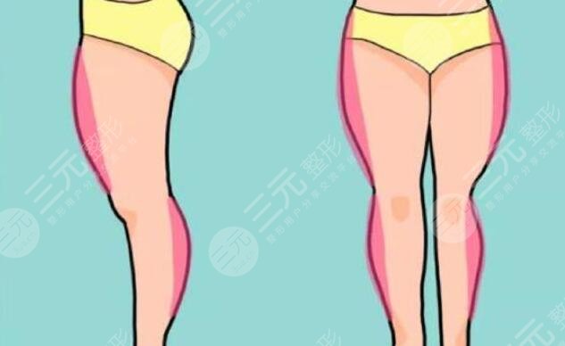 吸脂大腿