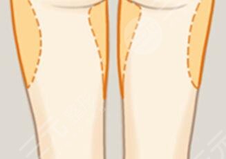 吸脂大腿