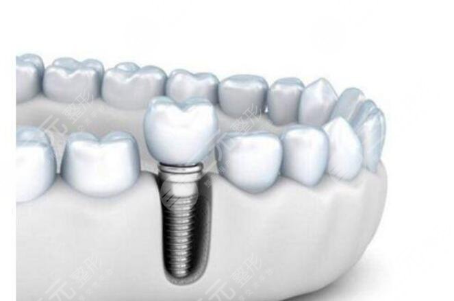 种植牙