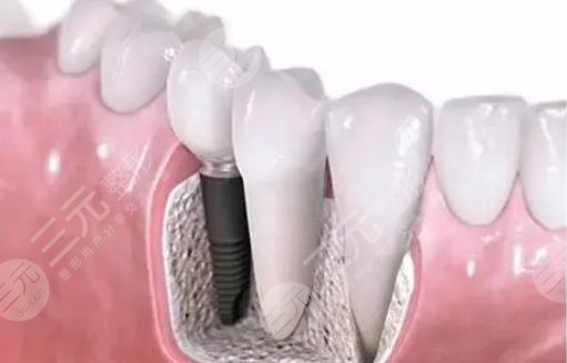 种植牙