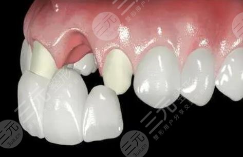 镶牙