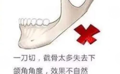 下颌角磨骨
