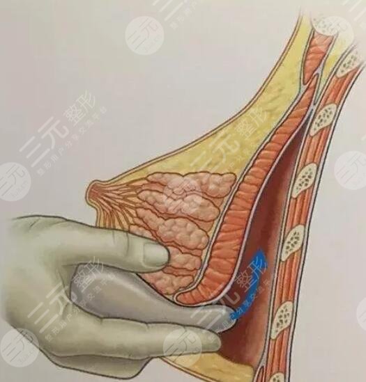 麦格假体隆胸手术的原理