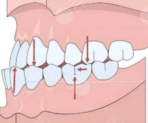 地包天手术整形费用会受生活地区的影响
