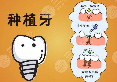 种牙好还是镶牙好?区别是什么?术前准备+术后护理盘点