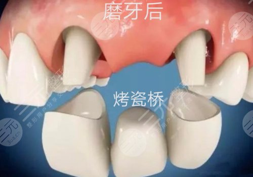 种牙好还是镶牙好?区别是什么?
