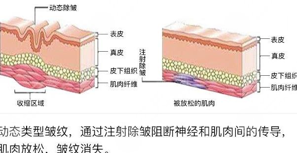 生物注射杆菌除皱