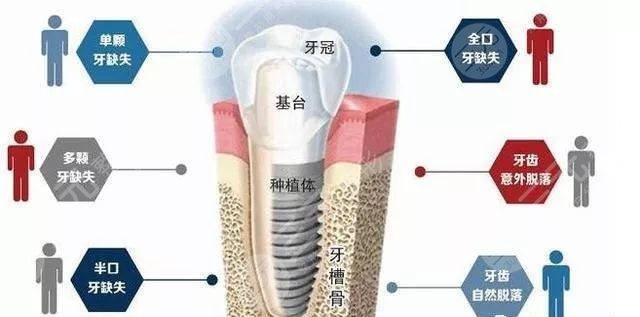 种植牙的寿命是长时间的吗?