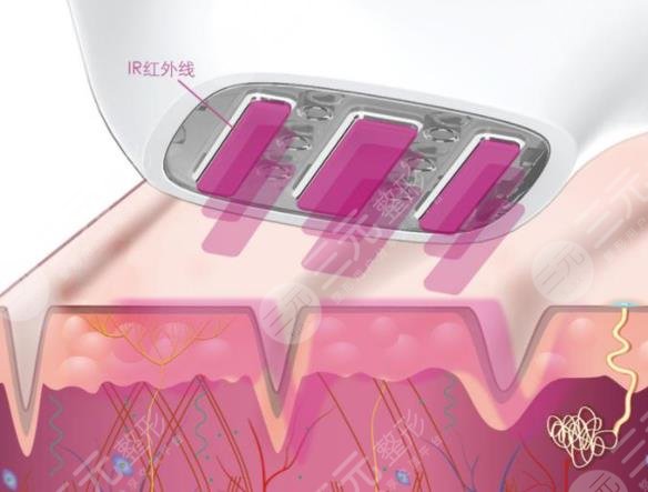 3d射频美容维持多长时间