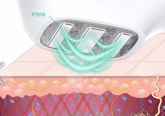 3d射频美容作用