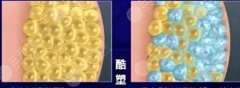 酷塑和吸脂哪个好？优势大PK，带你诠释“躺瘦”是怎么完成的！