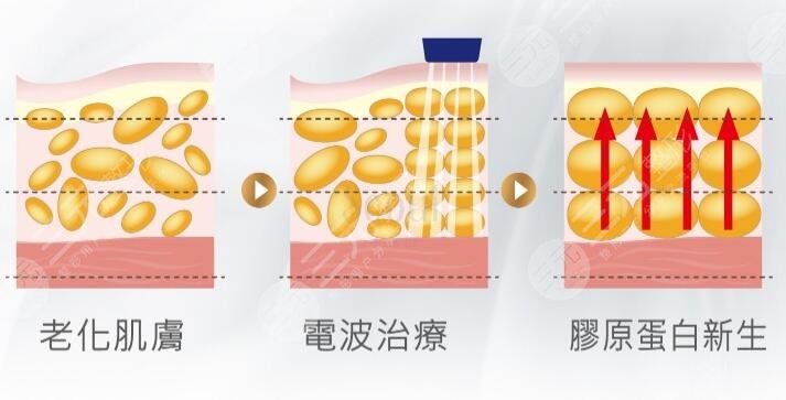 什么是电波拉皮手术