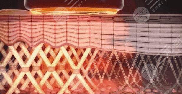 射频除皱手术术后需要怎么护理