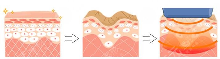 3D射频美容手术的操作原理