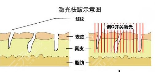 点阵激光除皱成好吗？激光除皱的优势|注射和激光哪个更好？
