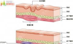玻尿酸除皱可以维持多长时间?3大原因影响了维持时间,是哪三点呢? 玻尿酸除皱可以维持多长时间?3大原因影响了维持时间,是哪三点呢?